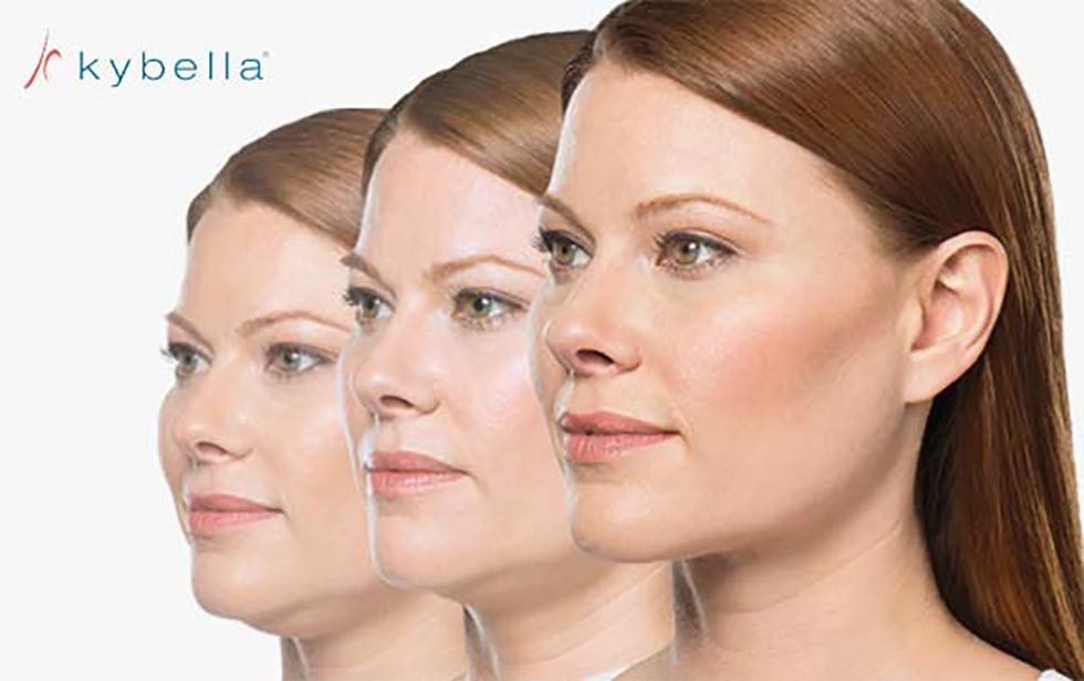 Kybella