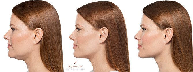 kybella