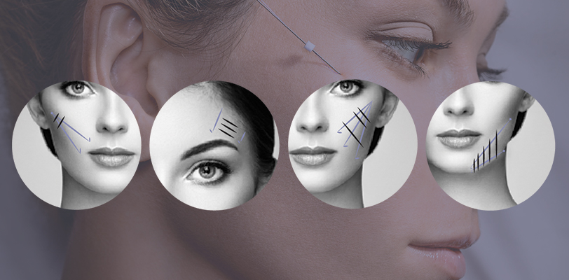 PDO Thread Lifts Northern Kentucky