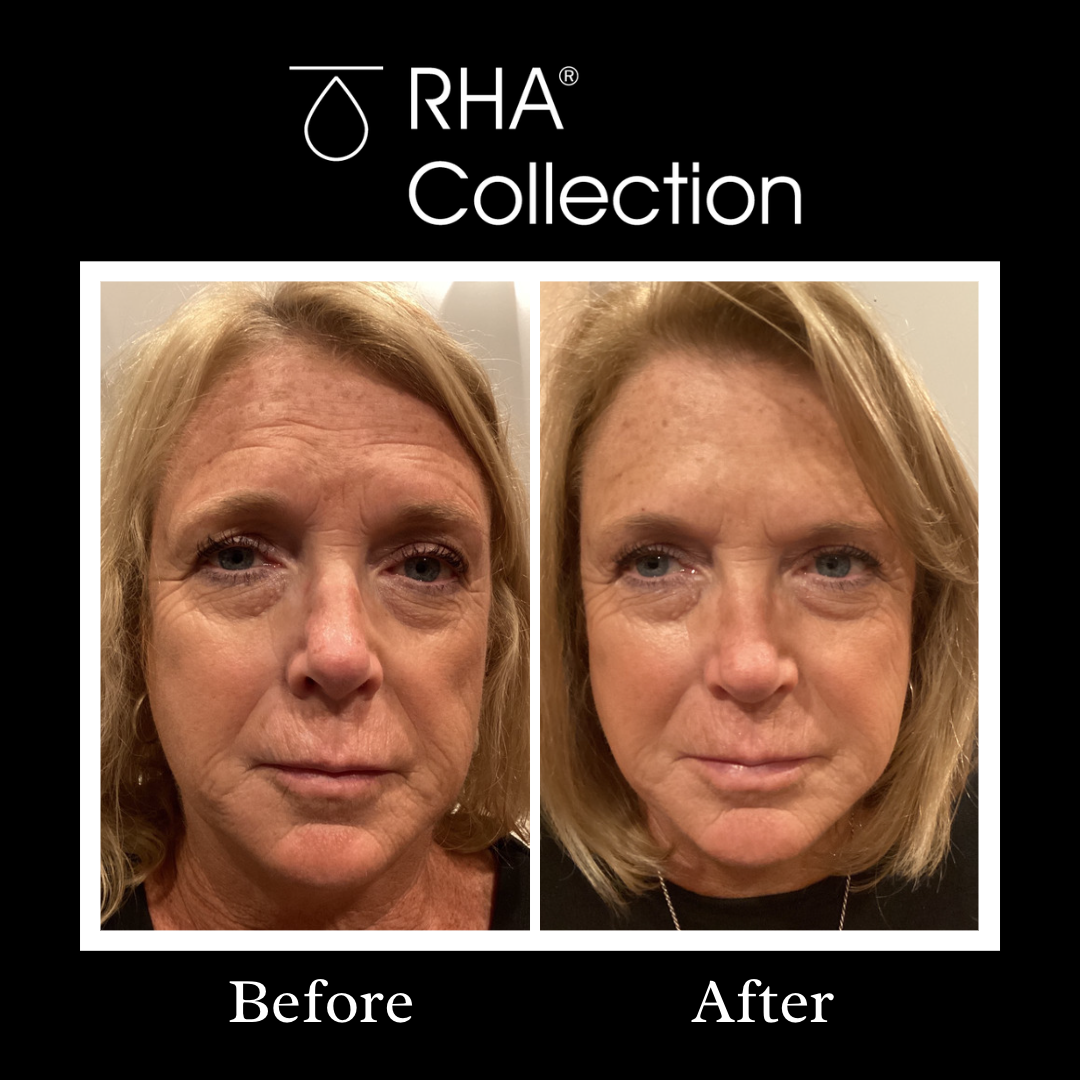 RHA Filler