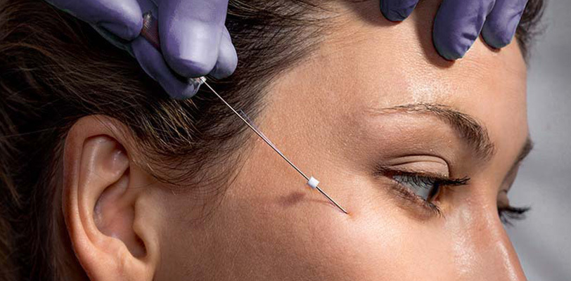 PDO Threads Before and After Gallery