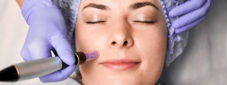 5 Benefits of Microneedling